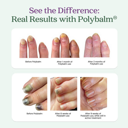 Polybalm® Natural Nail Care Balm for Chemotherapy - Doctor-Developed ...