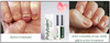 Polybalm – The Only Clinically Proven Nail Balm to Prevent & Repair Chemo Nail Damage | 100% Natural