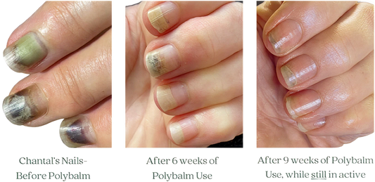 Before & After Polybalm® — Real Patient Results | Polybalm USA ...